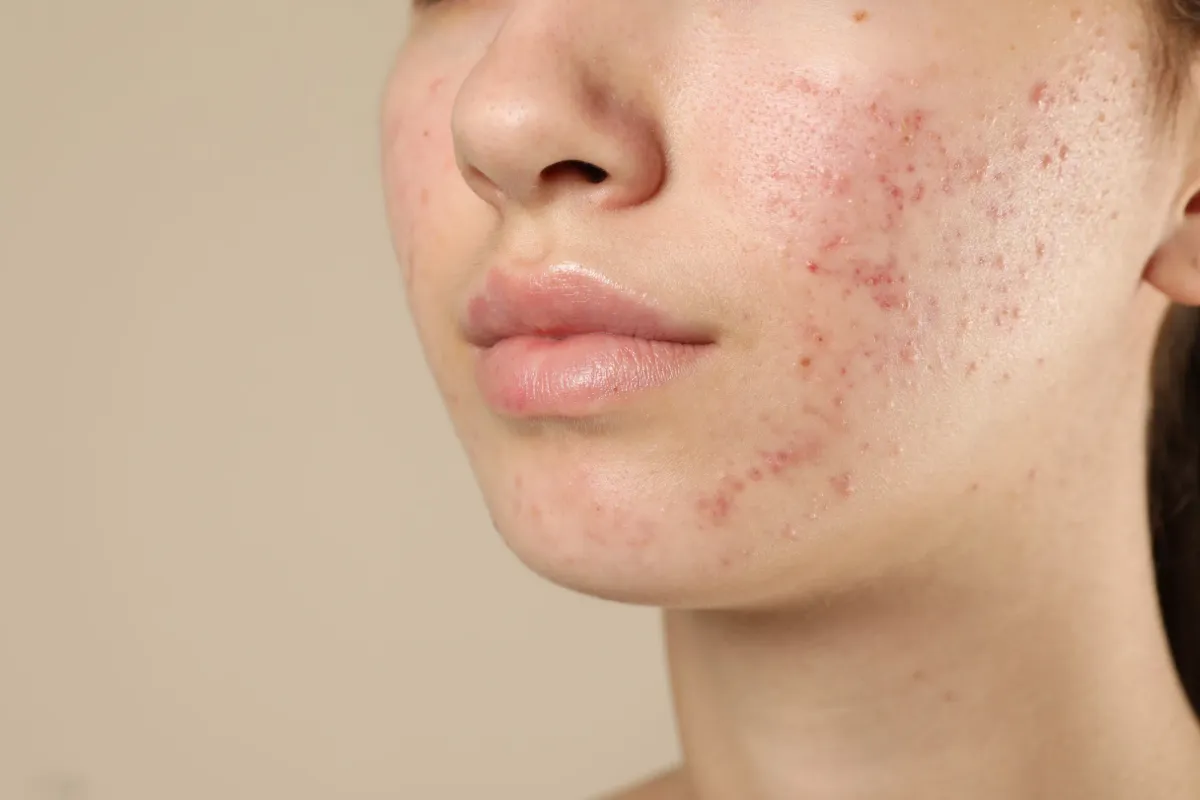 Visage d'une femme présentant une acné du bas du visage