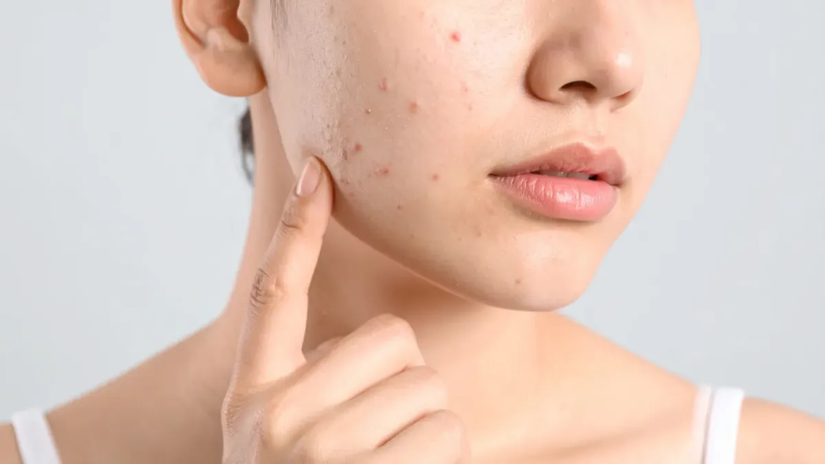 Gros plan sur le visage d'une femme présentant de l'acné sur la joue
